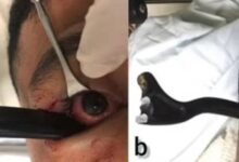 صورة عملية جراحية في عين رجل لإخراج “مقبض فرامل”