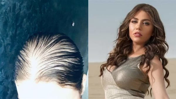 الفنانة "رحمة حسن" تصدم جمهورها بإعلان إصابتها بـ"الصلع".. القصة الكاملة وأسباب الحالة
