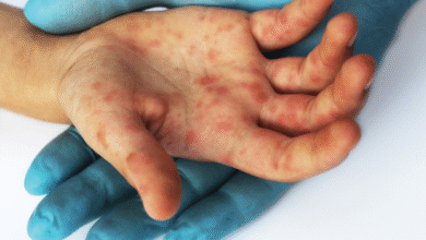 صورة بعد إصابة 4 طلاب.. ما هو فيروس “HFMD” الذي أثار القلق في مدارس الجيزة؟