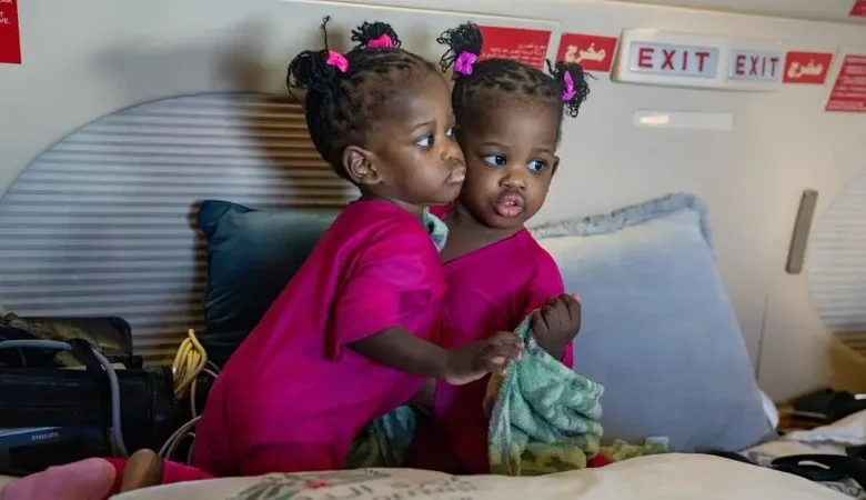 ملحمة إنسانية في الرياض.. المملكة تبدأ أولى مراحل فصل التوأم السيامي الجامايكي «أزاريا وأزورا» في عملية معقّدة تمتد 9 ساعات