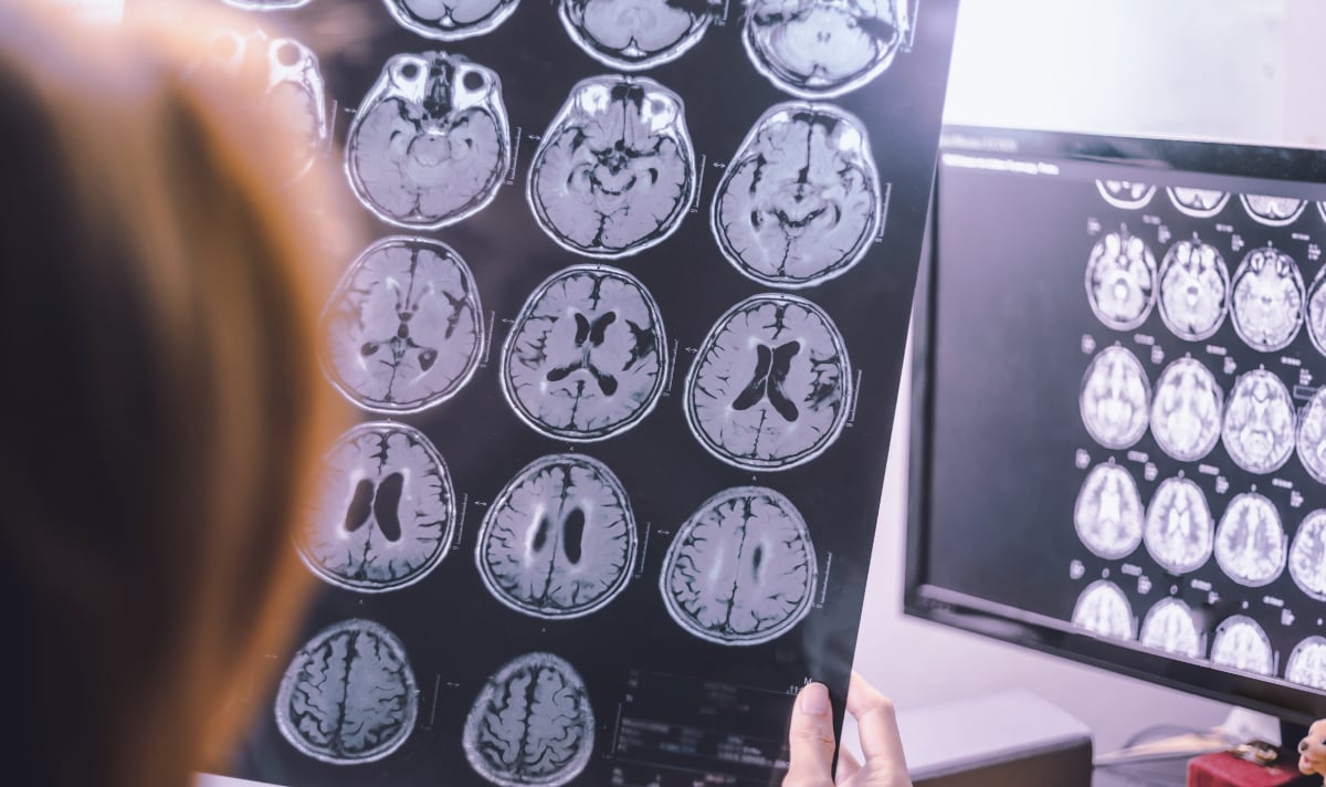 عملية دقيقة تنقذ حياة مريض أربعيني بعد نزيف دماغي حاد في مستشفى الدرعية