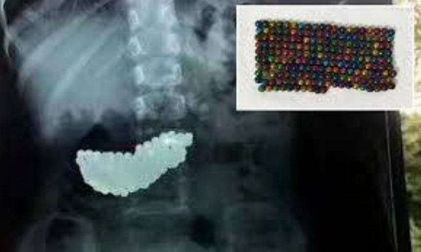 عملية دقيقة في الدمام.. أطباء ينجحون في استخراج 49 مغناطيسًا من بطن طفل باستخدام المنظار