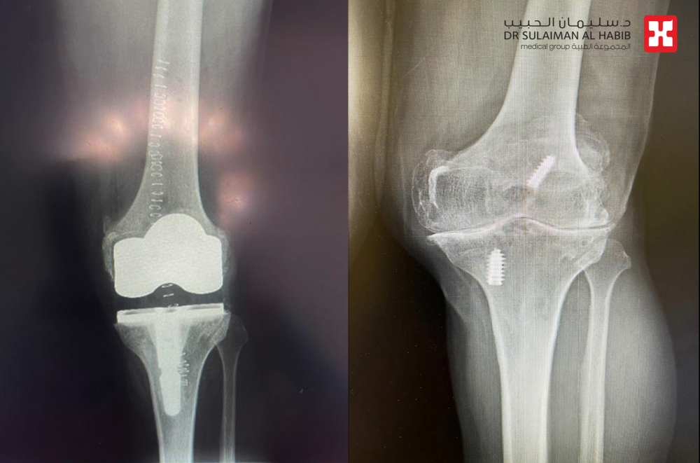 الروبوت يعيد خطوات الحياة… مستشفى الدكتور سليمان الحبيب بالخبر يعالج ثمانينية من آلام الركبة ويمنحها القدرة على المشي من جديد