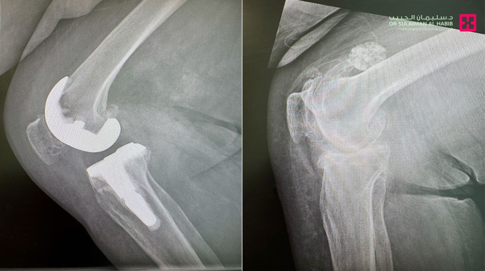 الروبوت يعيد خطوات الحياة… مستشفى الدكتور سليمان الحبيب بالخبر يعالج ثمانينية من آلام الركبة ويمنحها القدرة على المشي من جديد