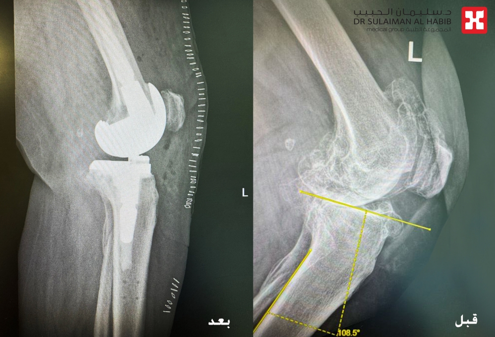 الروبوت يعيد خطوات الحياة… مستشفى الدكتور سليمان الحبيب بالخبر يعالج ثمانينية من آلام الركبة ويمنحها القدرة على المشي من جديد