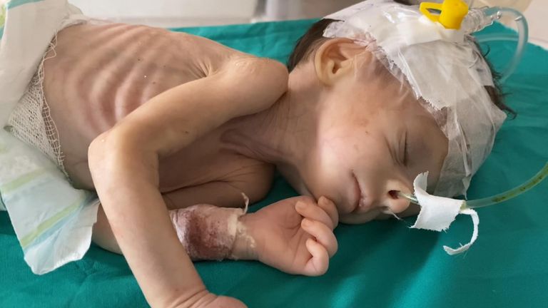 كارثة صحية صامتة في غزة.. 1500 طفل و42% من الحوامل على حافة الموت