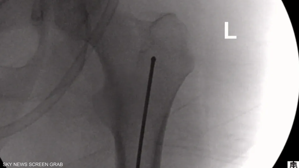 بتقنية متقدمة تعيد الحركة من جديد.. مستشفى المانع ينجح في علاج حالة معقدة من خشونة الركبتين