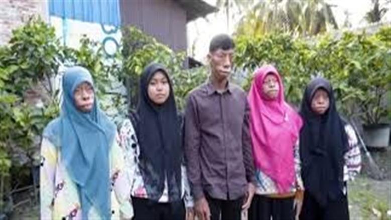 «ملعونة بأرواح شريرة».. القصة الكاملة لعائلة وُصمت بوجوه السحالي قبل أن تكشف الحقيقة الصادمة