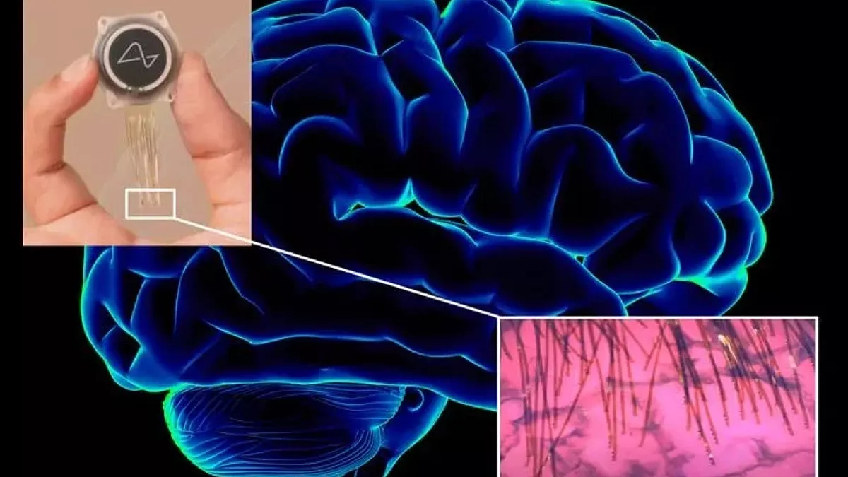 شريحة في الدماغ تغيّر حياة إنسان.. أول مزروع بشريحة عصبية يتحدث أمام قادة العالم