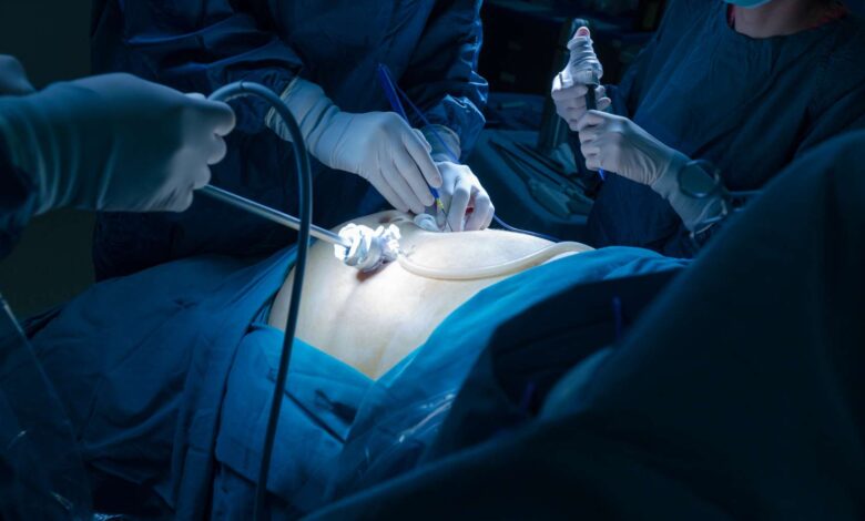 تقنية «الفتحة الواحدة» تنهي معاناة مريضة 15 عامًا في إنجاز طبي متقدم بالرياض